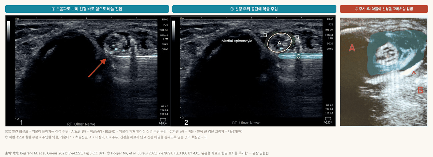 팔꿈치터널 척골신경 초음파 유도 신경주위 주사 - 바늘 진입, 신경 주위 공간에 약물 주입, 주사 후 약물이 신경을 감싼 모습