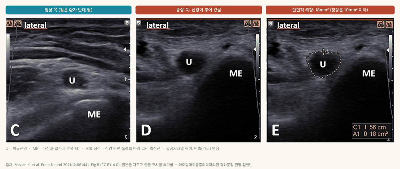 팔꿈치터널 높이 척골신경 초음파 단축 영상 - 정상 쪽과 증상 쪽 비교, 부은 신경의 단면적 18mm² 측정