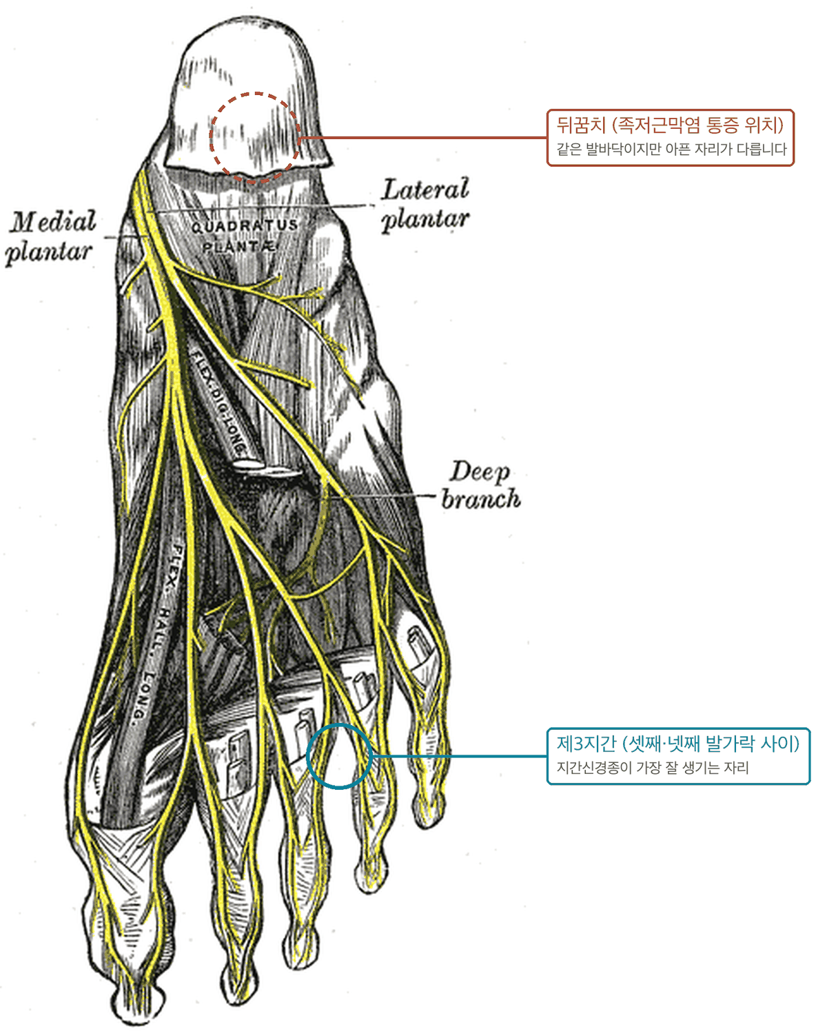 발바닥 신경 해부 도판 - 안쪽·바깥쪽 발바닥신경이 발가락 사이로 갈라지는 모습, 셋째·넷째 발가락 사이 제3지간을 청록 원으로, 족저근막염 통증 위치인 뒤꿈치를 테라코타 점선으로 표시