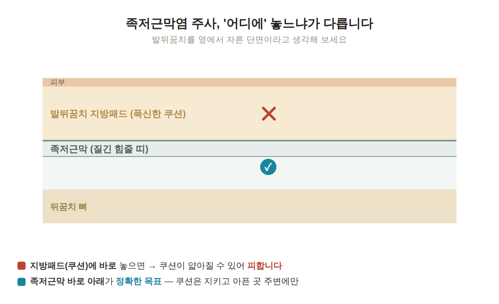 족저근막염 주사에서 약이 남을 수 있는 세 층 - 발뒤꿈치 지방패드는 피하고, 족저근막 바로 아래를 목표로 하는 단면 모식도