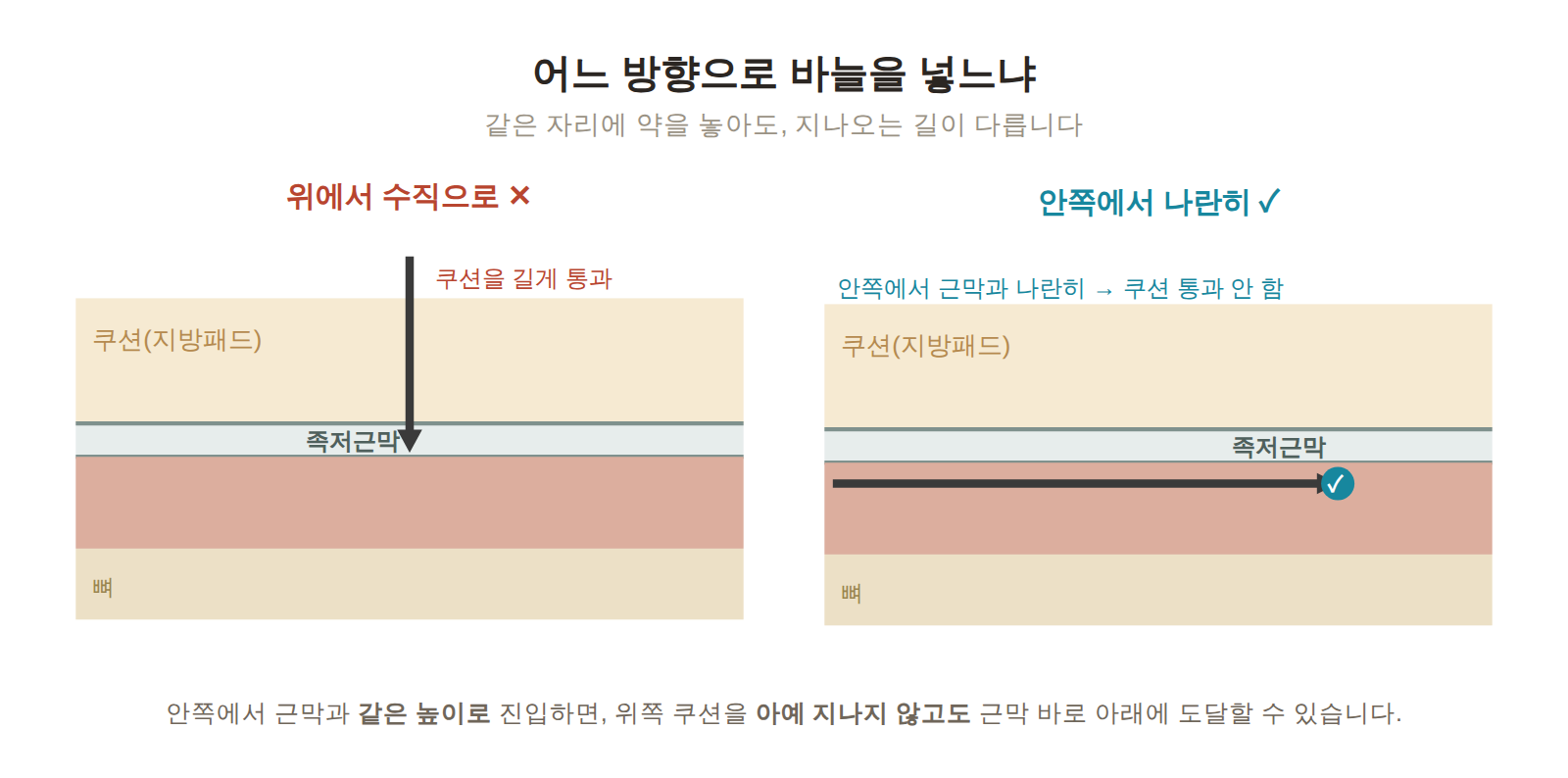 족저근막염 주사 바늘 방향 비교 - 발바닥에서 수직 진입은 지방패드를 길게 통과하고, 발 안쪽에서 근막과 나란한 진입은 지방패드를 지나지 않음