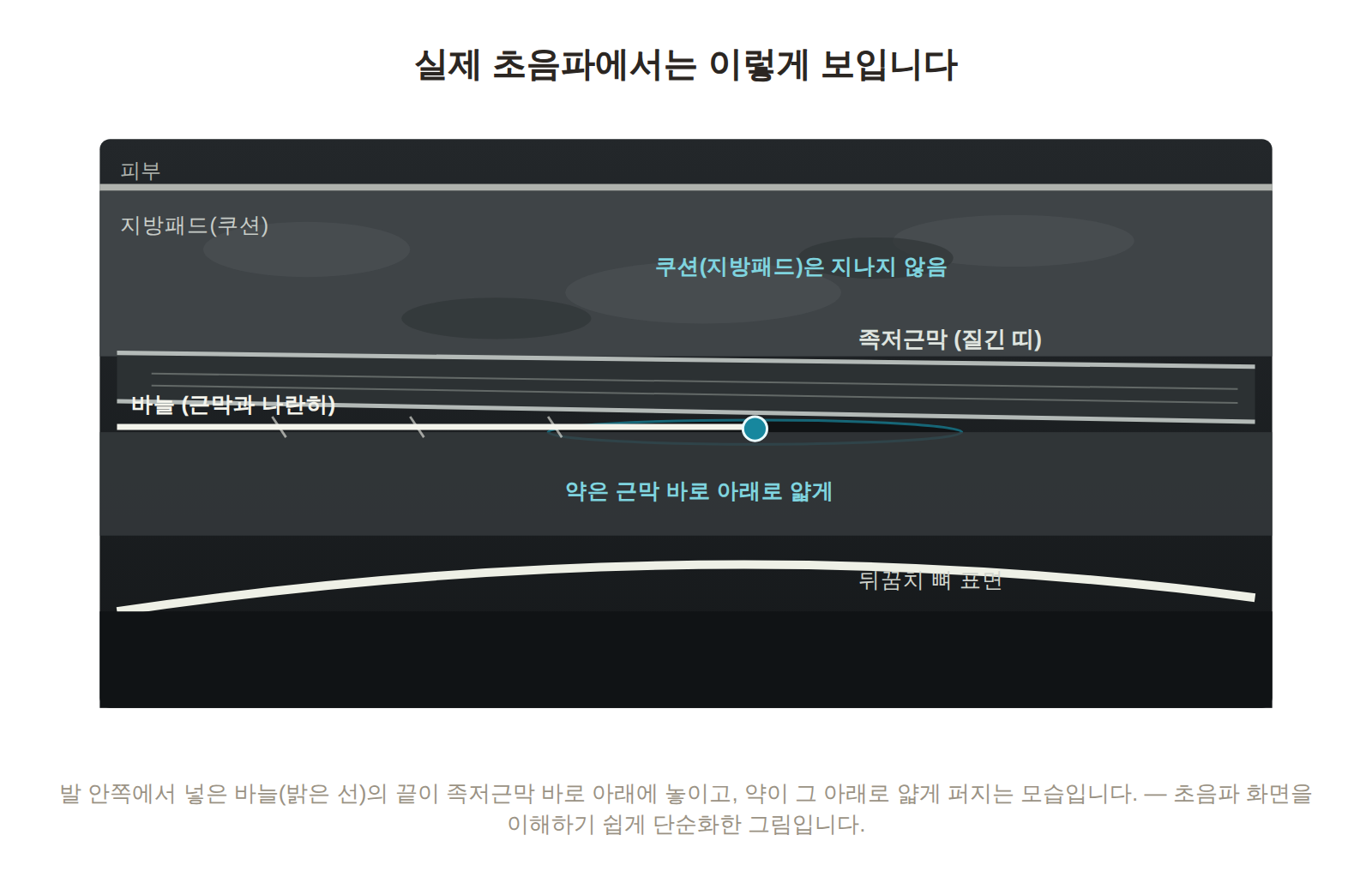 족저근막염 초음파 유도 주사 모식도 - 발 안쪽에서 들어온 바늘 끝이 족저근막 바로 아래에 놓이고 약이 근막 아래로 얇게 퍼지는 모습
