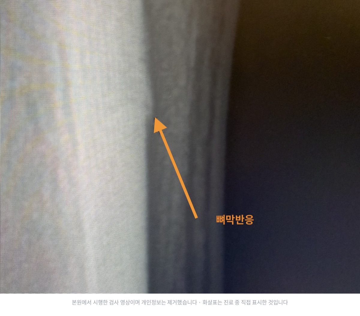 정강뼈를 확대한 단순 X선 영상. 화살표가 가리키는 뼈 바깥 경계를 따라 얇은 새 뼈 층이 겉질과 나란히 보인다